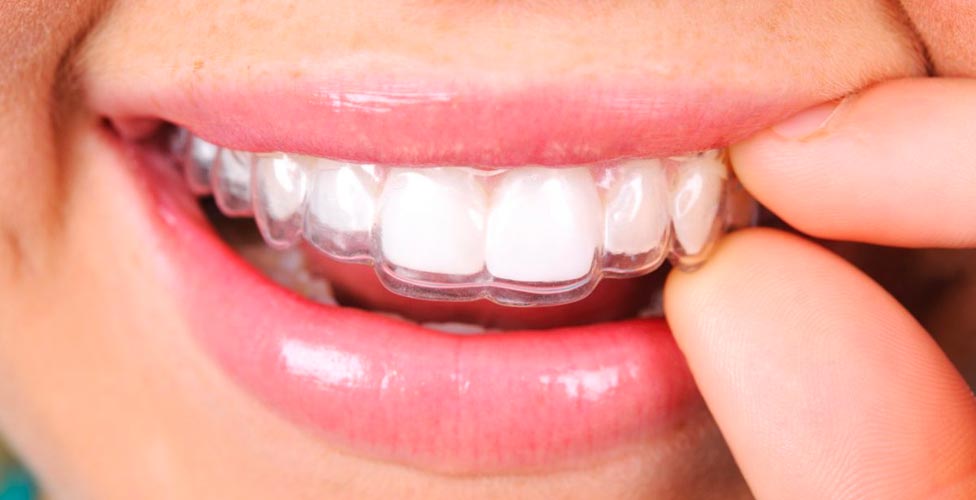 Invisalign close-up