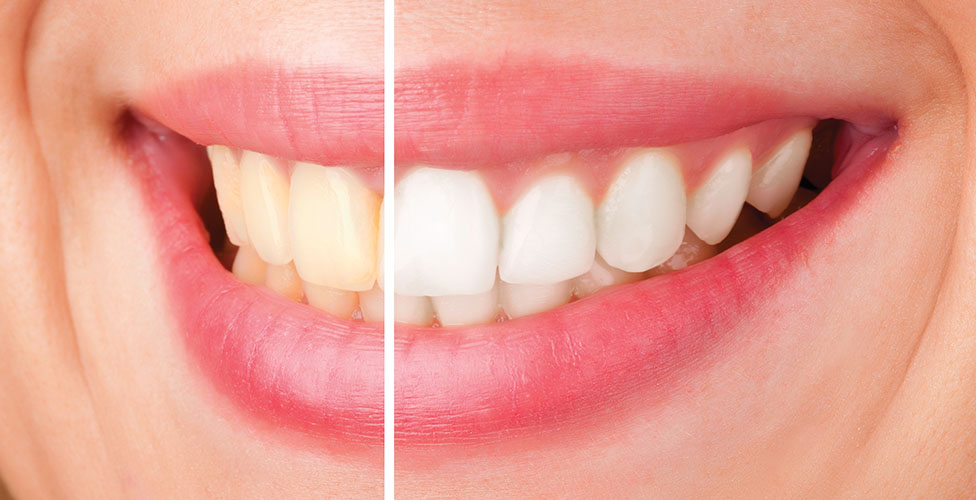 Whitening treatment